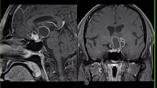 neuroradiology masterclass P7 [upl. by Eipper]