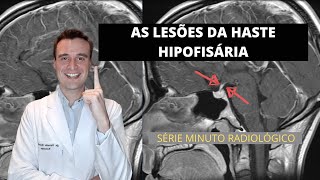 As lesões da haste hipofisária na ressonância Série radiologia em 1 minuto shorts [upl. by Mannes]