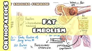 Fat Embolism Syndrome simplified for USMLE NCLEX NEET PG INICET NORCET [upl. by Anawed]