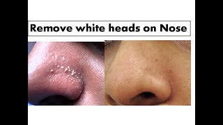 Turmeric to remove White heads on Nose Starnaturalbeauties [upl. by Annaynek]