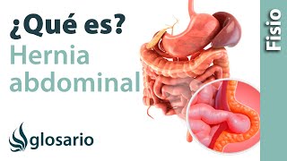 Cirugía de hernia ¿Cuáles son las posibles complicaciones [upl. by Daigle]