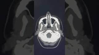 Venous Sinus Thrombosis CT head and CT Venogram [upl. by Hamfurd]