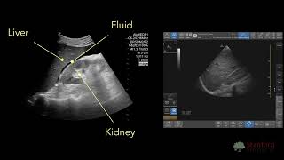 Point of Care Ultrasound for Ascites POCUS [upl. by Chor111]