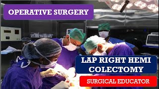 LAP RIGHT HEMICOLECTOMY STEP BY STEP OPERATIVE SURGERY [upl. by Dolf153]