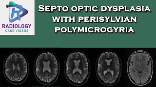 Septo optic dysplasia with perisylvian polymicrogyria [upl. by Leban]