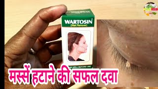 Wrtosin wart remover अपने मस्सों को हटाए हमेशा के लिए। [upl. by Zeuqram]