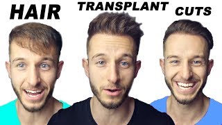 My 3 Favorite Hairstyles After My Hair Transplant [upl. by Tenrag518]