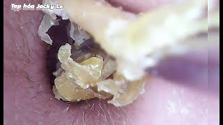 Ear Wax Removal 99 Itching And Sleepless Because Of A Lot Of Earwax  Ear Cleaning ASMR [upl. by Lilac]