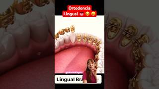 Brackets linguales 👅 ortodoncia ortodoncialingual brackets bracketslinguales orto [upl. by Amias]