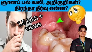 ஞானப் பல் வலி  பிரச்சனைகள்  தீர்வுகள் Wisdom teeth pain and treatment in tamil [upl. by Livi565]