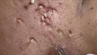 You Wont Believe How Easy It Is to Remove Blackheads [upl. by Abibah]