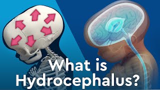 What is Hydrocephalus and Why Does Fluid Build Up in the Brain [upl. by Norag]