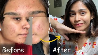 This Changed my life…  No product  No doctor  Acne journey Tamil [upl. by Lissie]