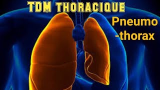 SCANNER THORACIQUE Pneumothorax avec collapsus passif [upl. by Nnyl]