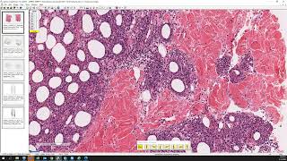 Subcutaneous panniculitislike Tcell lymphoma [upl. by Plato397]