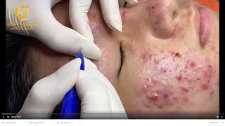 Treatment of acne tablets pustules and blackheads 359  Loan Nguyen [upl. by Ellerahc649]