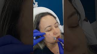 Rejuvenate Your Under Eyes with Belotero HA Filler at Plantation Med Spa Florida shorts [upl. by Egres]