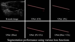 Needle Segmentation Using GAN Restoring Thin Instrument Visibility in Robotic Ultrasound [upl. by Vera]