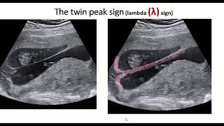 Twin peak sign or lambda sign  feature of dichorionic diamniotic twin pregnancy [upl. by Euell]