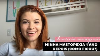 MINHA MASTOPEXIA  1 ANO DEPOIS [upl. by Hnacogn652]