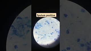 Sputum for AFB Test AFB Slide testshort ytshortsyoutubeshortsviralvideoviralshorts [upl. by Herzog]