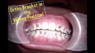 Orthodontic Bracket Repositioning [upl. by Rozalin]