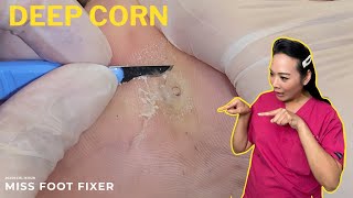 DEEP CORN REMOVAL😍 [upl. by Thorne]