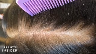 How Severe Dandruff Is Removed From The Scalp  Insider Beauty [upl. by Nortna885]