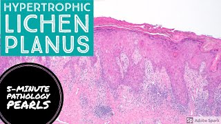 Hypertrophic Lichen Planus 5Minute Pathology Pearls [upl. by Faux]