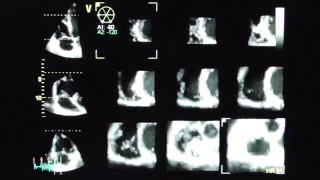 Rechter Ventrikel mit MultiSliceBildgebung  right ventricle with multislice imaging [upl. by Sefton]