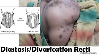 Recti DivaricationDiastasis  Abdominal Hernia [upl. by Tallia]