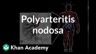 Polyarteritis nodosa  Circulatory System and Disease  NCLEXRN  Khan Academy [upl. by Akemahs]