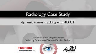 TOSHIBA Aquilion presents 4D CT in Lung Cancer Staging [upl. by Ayinat]