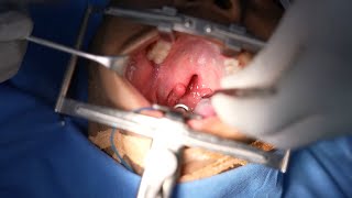 Adult Cleft Palate Surgery for Clear Speech  Richardsons Hospital [upl. by Anaeli294]