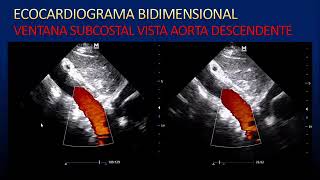 Generalidades de ecocardiograma doppler color [upl. by Millard]