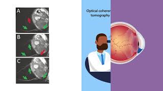 Aqueous humour outflow imaging seeing is believing [upl. by Fugere36]