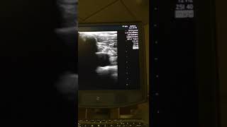 PulmCrit Shrug technique for ultrasoundguided subclavian [upl. by Colston]