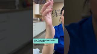 Example of ulnar palsy patient with a claw deformity with PIP joint contracture [upl. by Nolham]