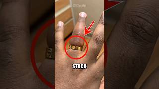 how to remove a ring stuck on finger [upl. by Notlehs]