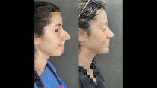 live Results before after for Rhinoplasty Surgery [upl. by Ahsienal]