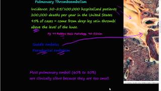 58PEtiology of Pulmonary embolism Saddle embolus Paradoxial embolism [upl. by Nae]