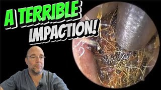 A TERRIBLE IMPACTION 291 ear earwax earwaxremoval foryou asmr asmrearwax satisfying [upl. by Lozar]