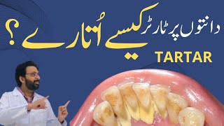 Tartar Teeth Treatment  Teeth Cleaning at the Dentist [upl. by Martres622]