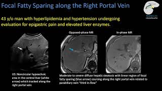 Hepatic Steatosis Part 3 Mimics and Pitfalls [upl. by Ecinrev]