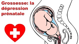 Grossesse la dépression prénatale EnceinteSante [upl. by Eus681]