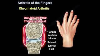 Arthritis Of The Fingers causes symptoms diagnosis and treatment [upl. by Sunev]