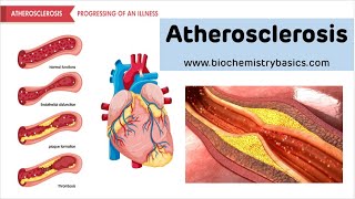 Atherosclerosis  Risk factors Pathophysiology and Prevention [upl. by Leahcin971]