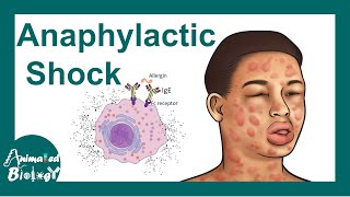 Anaphylactic shock  Anaphylactic Reaction Symptoms and Treatment [upl. by Analaf105]