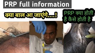 PRP therapy for Hair loss treatment  plateletrich plasma  in hindi [upl. by Soph791]