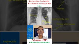 Implantable Cardioverter Defibrillator on Chest XRay [upl. by Dinse]